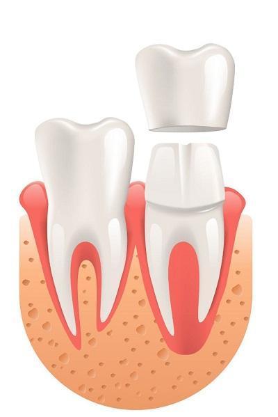 dental crown | el dorado hills ca
